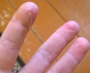 piele Oblazit pe degetele de la copii și adulți o iritație obișnuită sau boli periculoase (oblazit) piele Oblazit pe degetele de la copii și adulți o iritație obișnuită sau boli periculoase