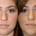 Deservirea nas rhinoseptoplasty preturi, fotografii, video, comentarii