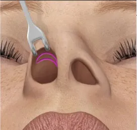 Deservirea nas rhinoseptoplasty preturi, fotografii, video, comentarii