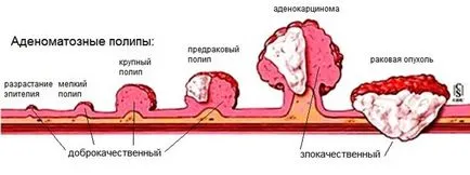 Cancerul de stomac tipuri de tumori benigne și maligne, cauzele si simptomele lor, tratament