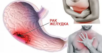 Cancerul de stomac tipuri de tumori benigne și maligne, cauzele si simptomele lor, tratament
