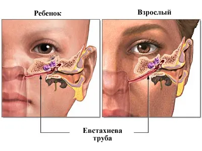 infecție acută a urechii