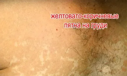 Pitiriazis (multicoloră) pecingine cauze, simptome, tratament