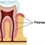 simptome de boala parodontala si tratamentul la domiciliu