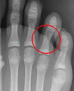Fracturile oaselor piciorului - cauze, simptome, diagnostic și tratament (fracturi ale piciorului) Fracturile oasele piciorului - cauze, simptome, diagnostic și tratament