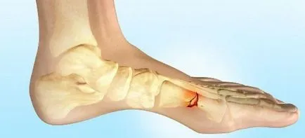 Fractura oasele metatarsiene ale piciorului - simptome, tratament, reabilitare după o fractură a oaselor metatarsiene (tratament) Fractura oasele metatarsiene ale piciorului - simptome, tratament, reabilitare după fractura oaselor metatarsiene
