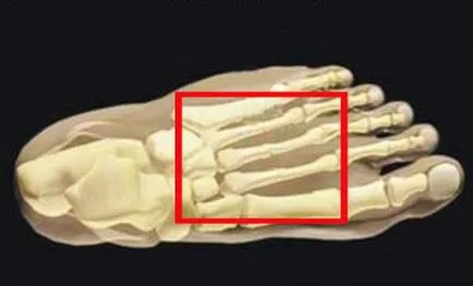 Fracturarea piciorului (metatarsiene,), tratat ca mers pe jos într-un ghips, simptomele