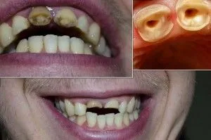 Sigiliul de pe PIN-ul ca face, am pus rănit pini (sigiliu) Sigiliul de pe PIN-ul ca face, am pus rănit PIN-ul