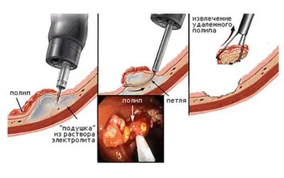 medaborta polip placentă după întreruperea tratamentului, după învățământul medical