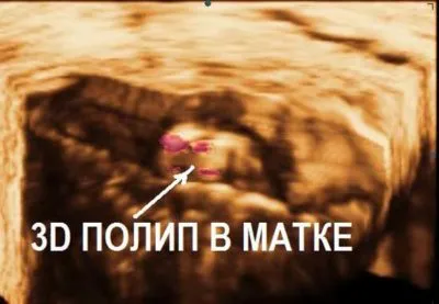 medaborta polip placentă după întreruperea tratamentului, după învățământul medical