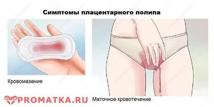 polip placentar - Simptome, cauze, tratament