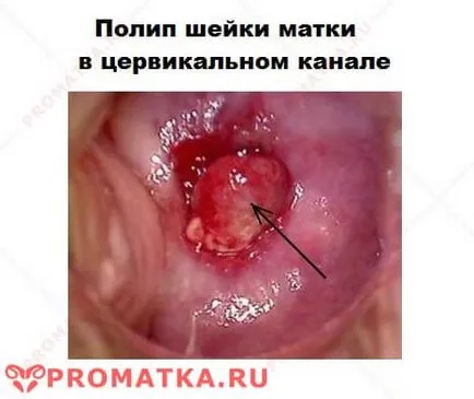 polip placentar - Simptome, cauze, tratament