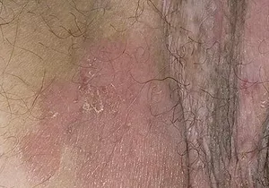 De ce mănâncă și pruriginoasă sub brațe, motivul - ciuperca sau dermatita (motiv) De ce mănâncă și pruriginoasă sub brațe, motivul - ciuperca sau dermatita
