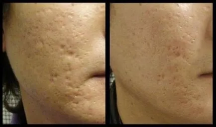 Unguent Kontraktubeks cicatrici ca crema se dizolvă vechi urme de acnee si a ridurilor