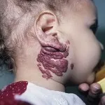 Cauzele și tratamentul hemangioame (foto) (tratamentul hemangiom al unui simptom al cauzei) Cauzele și tratamentul hemangioame (foto)
