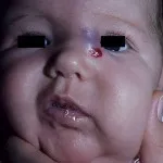 Cauzele și tratamentul hemangioame (foto) (tratamentul hemangiom al unui simptom al cauzei) Cauzele și tratamentul hemangioame (foto)