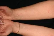 Acneea este similar cu ce apar mușcături, și cum să le vindece