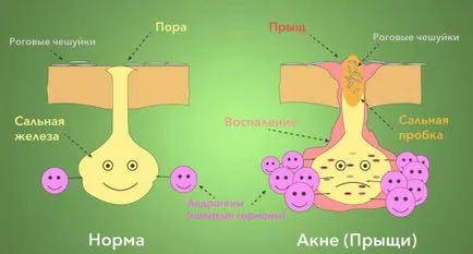 Acneea este din cauza hormonilor la femeile ce să facă, ce teste trebuie să ia (orice) Acneea este din cauza hormonilor la femeile care fac, ce analize vor să predea