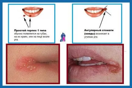 Răceli facial - tratamentul răcelii comune