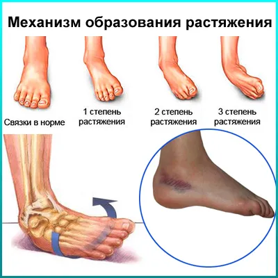 tendon specifice stretching tratament prejudiciu