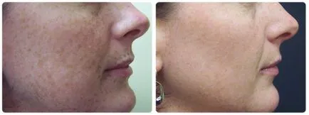 Cum de a întineri tratamente ale pielii faciale, resurfacing cu laser, peeling chimic