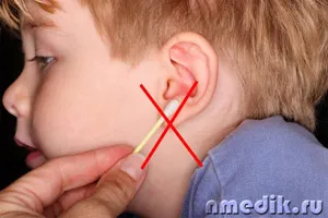 Cerumen în ureche - cum să-l eliminați