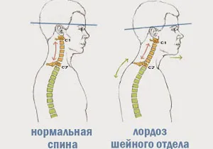lordoza cervicala este indreptat (netezite) - simptome, cauze si tratamentul bolii coloanei cervicale