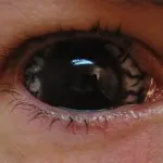 lentile scleral - o descriere, fotografii, istorie de apariție
