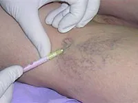 Pentru prevenirea varicelor ciorapi, creme, pastile, și alte medicamente