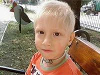Stenoza a laringelui la copii - tratament, cauze si simptome (copii) Stenoza a laringelui la copii - tratament, cauze și simptome
