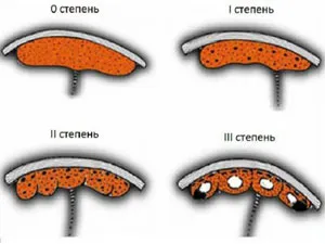 gradul de maturitate a placentei de săptămâni în tabel (săptămâni) săptămânal în gradul de maturitate Tabelul placentei