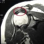 RMN a articulației umărului ca face acest lucru poate fi găsit (umăr) RMN al articulației umărului ca face, care pot fi detectate
