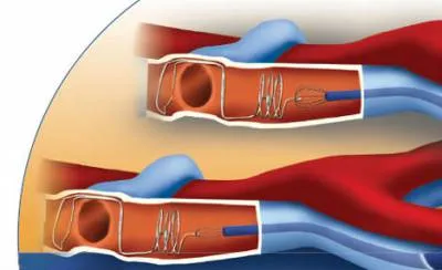 prognosticul embolismului pulmonar, cauze, clinice și de prim ajutor