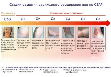 ulcer trofice tratamentul acasă picior