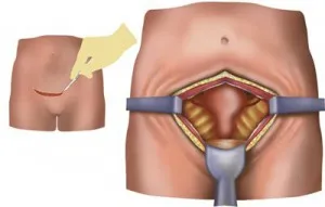 Eliminarea fibrom uterin, care este o modalitate mai bună (felul) Eliminarea fibrom uterin, care este o modalitate mai bună