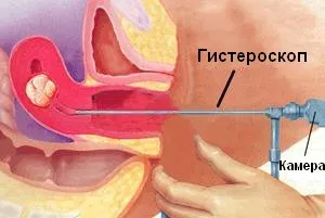 Eliminarea fibrom uterin care metoda este mai bine (text eliminat) Eliminarea fibrom uterin, care este o modalitate mai bună
