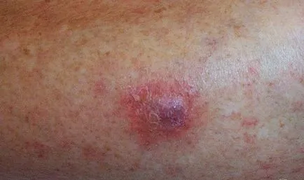 Prin îndepărtarea verucilor cu azot lichid