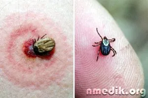 mușcături de insecte - simptome de sevraj și tratament (robinet săpun apă) mușcături de insecte - simptome de sevraj si de tratament