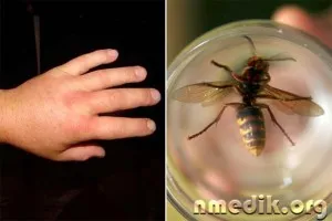 mușcături de insecte - simptome de sevraj și de tratament (posibil letal) mușcături de insecte - simptome de sevraj si de tratament