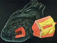angina vasospastică (aceeași variantă, Prinzmetal spontană) (angina) angina vasospastică (aceeași variantă, Prinzmetal spontană)