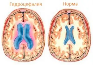 ICP simptomelor sugari, tratament, masurata