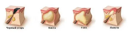 Tipuri de acnee, clinica medicala
