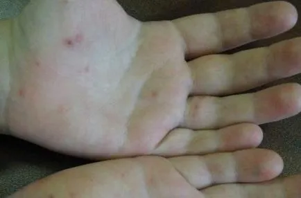 pemfigus virale la copii ce este