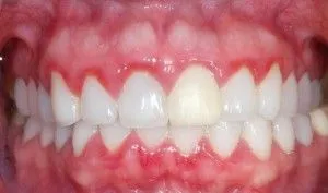 Afecțiunile gingivale ce să facă și cum să se vindece (tratament) Afecțiunile gingivale ce să facă și cum să trateze