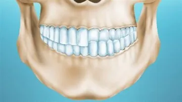 Overbite (maxilarul inferior este deplasat înainte) repara cu ajutorul sistemelor ortopedice și