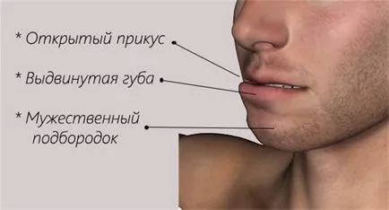 Overbite (maxilarul inferior este deplasat înainte) repara cu ajutorul sistemelor ortopedice și