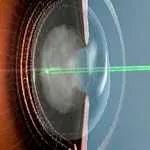 cataractă secundară cataractă secundară de restaurare vedere