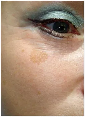 Varsta de pigment, cauza, cum să scape