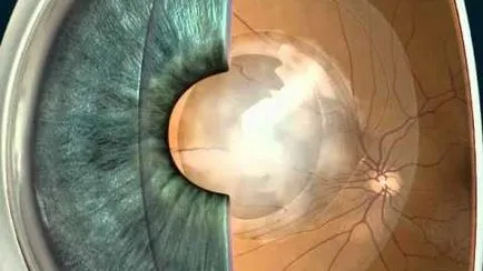 cataractă secundară după înlocuirea tratamentului lentile, diagnostic, simptome