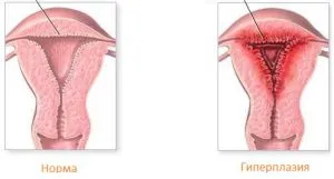 hiperplazie glandulara endometriala ceea ce este (a) hiperplazie endometriala glandulara ce este